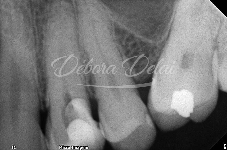 Tratamento endodôntico de dentes com lesões endo-periodontais