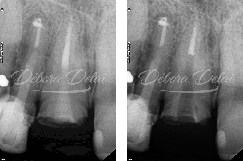 Tratamento endodôntico de dentes com lesões endo-periodontais