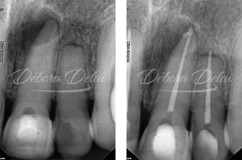 Tratamento endodôntico de dentes com lesões endo-periodontais