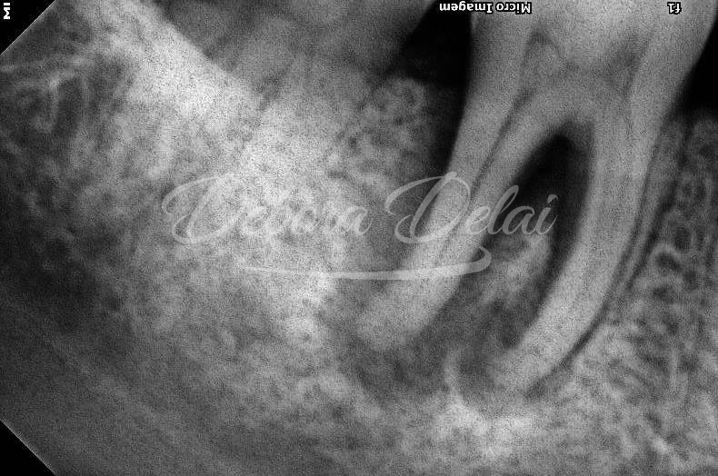 Tratamento endodôntico de dentes com lesões endo-periodontais