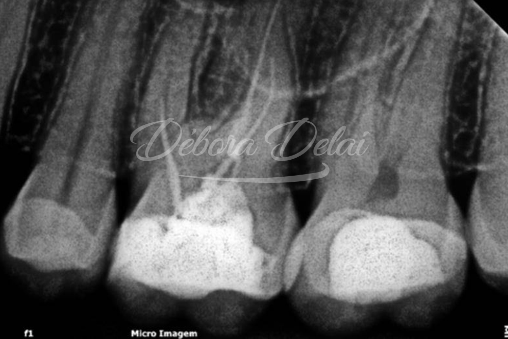 Retratamento Endodôntico